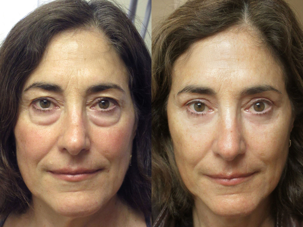 Original reference comparison from Zencial / EnvySkin; not verified Lumo results