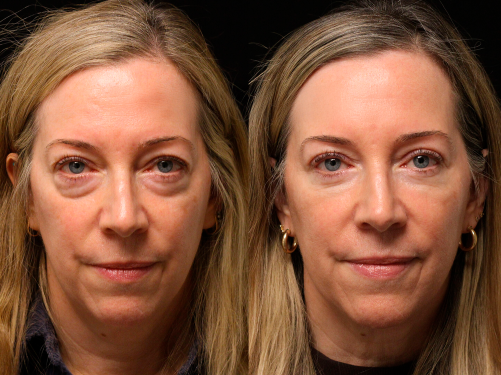 Original reference comparison from Zencial / EnvySkin; not verified Lumo results
